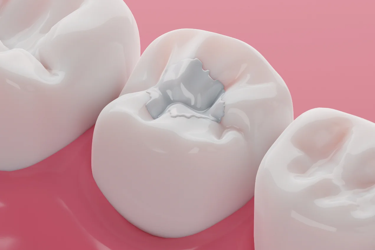 White Fillings Coventry - Light Lane Dental Practice