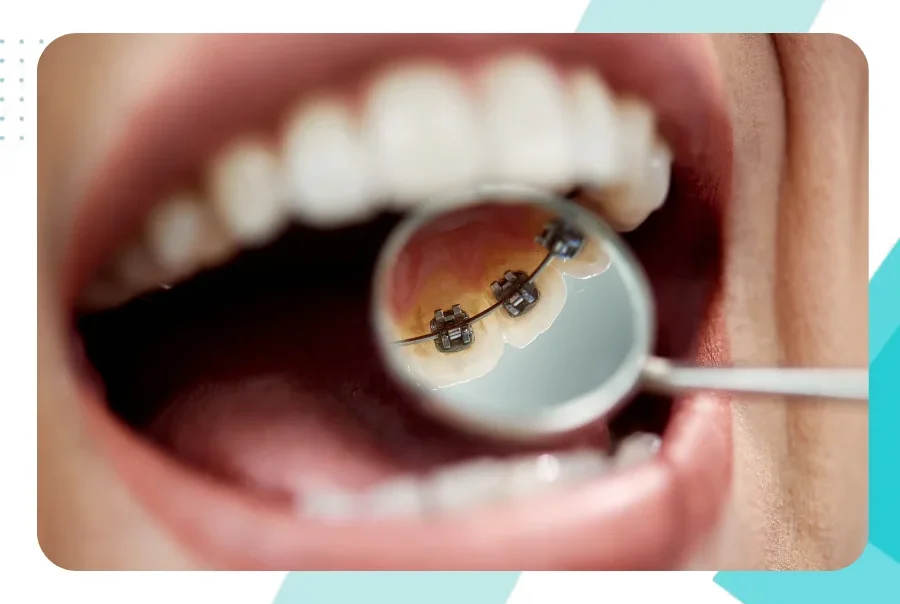 lingual braces hero